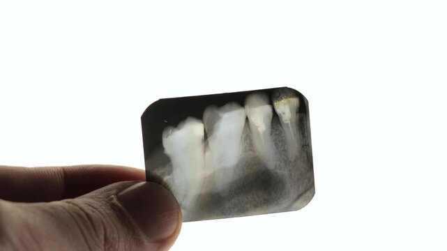 X-ray of a diseased teeth with dental fillings.