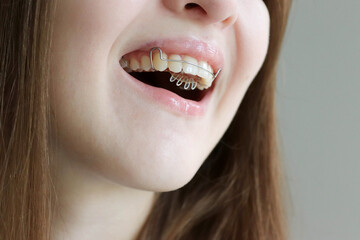 Close up of a woman smiling with removable orthodontic appliance in mouth. Orthodontic treatment...