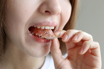 Retainer for teeth. Dental plate. Woman putting on  orthodontic retainers.