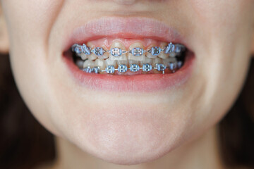 Obraz premium This image shows a close up of a persons mouth featuring braces on their teeth