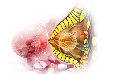 Female Breast cross section anatomy with cancer cells, medicine therapy. 3d illustration.