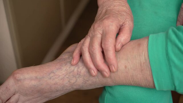 Elderly woman stress with pain for varicose veins, swollen blue veins on legs. Close up wrist and senior person with vascular occlusion, indication for surgery and prosthetics. Care for elderly