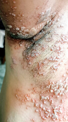 A Close up view of women with shingles (herpes zoster) disease on skin and he feel very painful