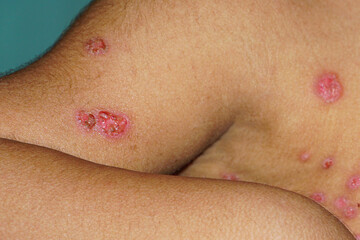Fototapeta premium Monkeypox or Mpox on the skin of a children 