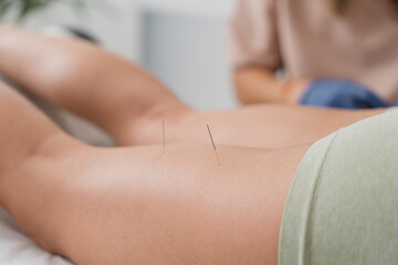 Physiotherapist applying acupuncture needles to patient's leg for pain relief