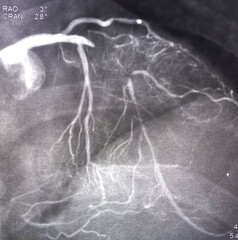 Coronary angiogram of left coronary artery during cardiac catheterization with contrast dye....