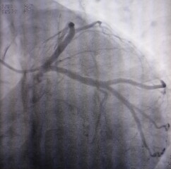 Coronary angiogram of left coronary artery during cardiac catheterization with contrast dye....