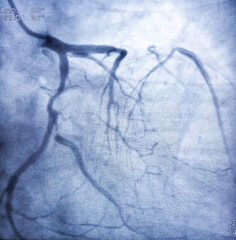 Coronary angiogram of left coronary artery during cardiac catheterization with contrast dye....