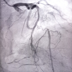 Coronary angiogram of left coronary artery during cardiac catheterization with contrast dye....