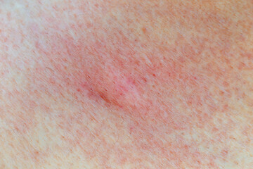 Fototapeta premium legs with many red spot and scar from Mosquito bites