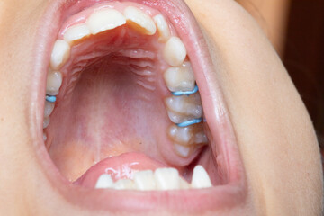 Orthodontic appliance expanding upper jaw of patient showing teeth and palate