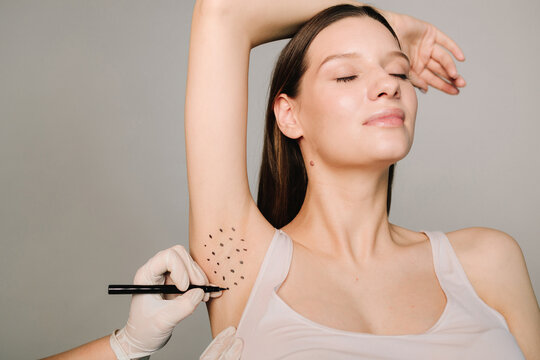 Markup skin for hyperhidrosis treatment in the clinic. Treatment of hyperhidrosis. Cosmetologist is marking dotes before injecting woman's armpit, closeup.