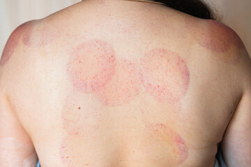 Fototapeta premium Hematomas on a woman's shoulders and back after a cupping massage procedure