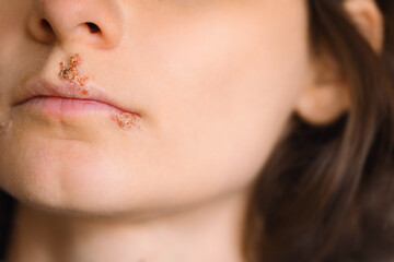 Close up of girl lips affected by herpes. Treatment of herpes infection and virus. Part of young...