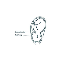 Bandl's Ring Gynaecological Medical Illustration