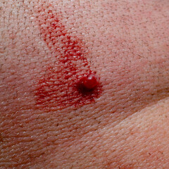 Damaged nevus on human skin with blood
