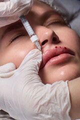 Lip Enhancement Procedure Injectable Treatment in Progress for a more stunning appearance