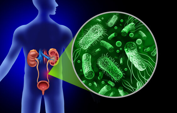 Urinary Tract Infection or UTI anatomy caused by bacteria as E coli with the kidneys ureters bladder and the urethra as Urethritis Cystitis Pyelonephritis and Ureteritis