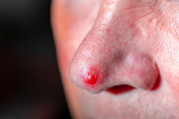 Health care concept, Selective focus of european man with red spot on the nose, Wound on tip of...