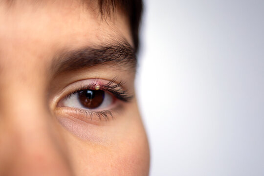 Close-up of human eye with small stye on upper eyelid in detailed macro view. Swollen and irritated skin around lashes. Health and medical concept for eye infection treatment and symptoms,