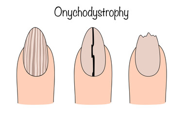 Obraz premium Onychodystrophy