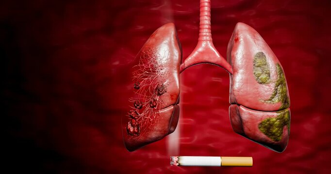 Lung cancer. Noncommunicable diseases or NCDs. Lung infections spread due to inhalation of cigarette smoke or dust. 3D Rendering.