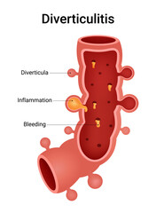 Causes of the Diverticular Diseases