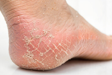 Fototapeta premium Close-up of cracked and dry heel skin