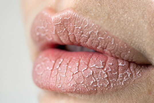 Close-up of dry, chapped lips needing hydration

