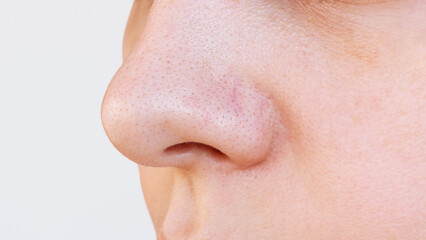 Close-up of young woman's nose with black heads or black dots on a white background. Acne problem, comedones. The girl with enlarged pores on the face. Blackheads on greasy skin