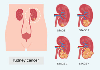 The stage describes how much cancer is in the body.