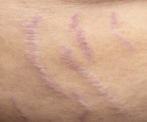 Fototapeta premium A person's arm has a series of purple marks on it