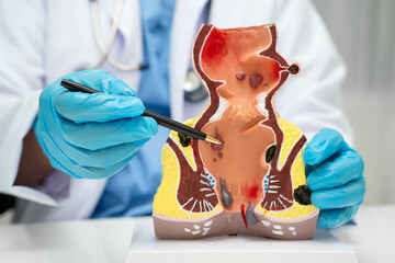 Asian doctor with rectum and hemorrhoid human anatomy model at hospital, inflamed vascular...