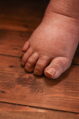 old seniors with swollen feet ,elderly people.edema or swelling in the feet.kidney or liver disease,Dry skin.Feet of a senior woman between 70 and 80 years old.Close-up .health problems concept