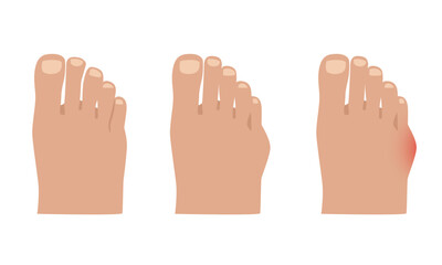 Obraz premium Taylor deformation. Valgus deformity of the little toe joint. Vector illustration.
