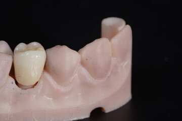 zirconia denture processing with dental digital cam/cad 