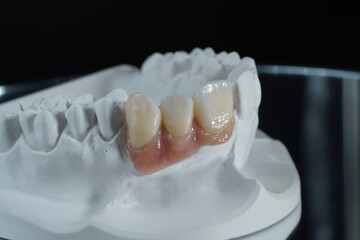 zirconia denture processing with dental digital cam/cad also with gingiva 