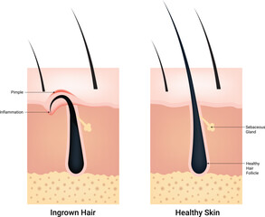 Ingrown Hair and Healthy Skin Science Design Vector Illustration Diagram