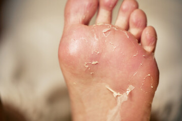 Woman feet showing peeling skin post beauty treatment