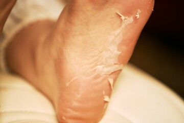 Fototapeta premium Patient relaxes her feet after a chemical peel treatment, revealing smoother, softer skin