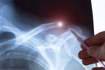 Doctor examining X-ray scan of  Dislocation of the acromial end of the clavicle.