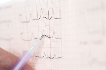 Doctor examining electrocardiogram. ECG show heart wave, cardiogram report. Learning Cardiovascular disease (CVD).