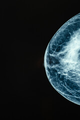 Xray Image of Breast Tissue intended for professional Medical Review and analysis