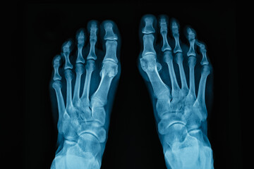 XRay Image of Human Feet Showing Intricate Bone Structure with Exceptional Detail