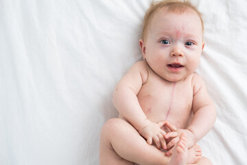 little girl with a scar from heart surgery