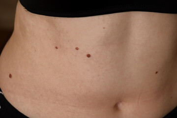 Unrecognizable woman showing her Birthmarks on skin Close up detail of the bare skin Sun Exposure effect on skin, Health Effects of UV Radiation Woman with birthmarks Pigmentation and lot of