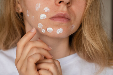 Unrecognizable woman applies makeup, cream serum cure for acne on face. Close-up acne on woman's...