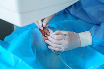 Surgeon Conducting Delicate Eye Surgery with Precision Tools