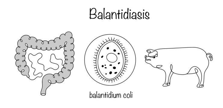 Balantidiasis