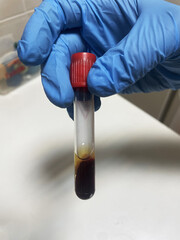 doctor holding blood sample, hand in protective latex gloves holding test tube with blood for test...